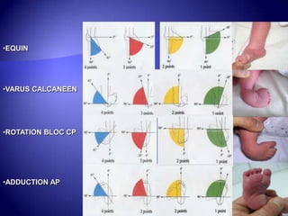 •EQUIN
•VARUS CALCANEEN
•ROTATION BLOC CP
•ADDUCTION AP
 