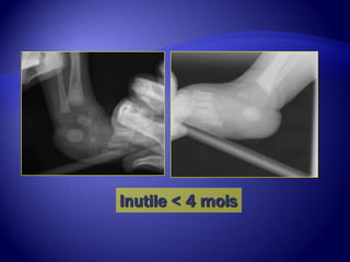 Inutile < 4 mois
 