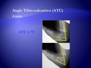 Angle Tibio-calcanéen (ATC)
4 mois
ATC  75
ATC < 75
85
50
 