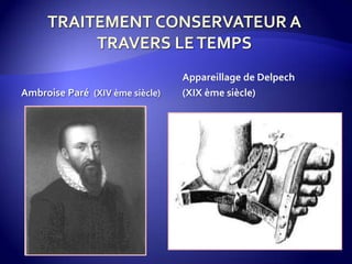 Ambroise Paré (XIV ème siècle)
Appareillage de Delpech
(XIX ème siècle)
 