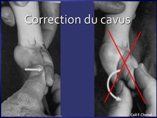 Correction du cavus
Coll F.Chotel
 