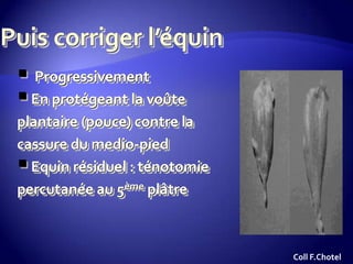  Progressivement
En protégeant la voûte
plantaire (pouce) contre la
cassure du medio-pied
Equin résiduel : ténotomie
percutanée au 5ème plâtre
Coll F.Chotel
 