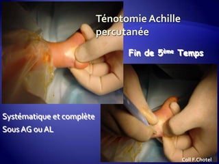 Systématique et complète
Sous AG ou AL
Fin de 5ème Temps
Coll F.Chotel
 