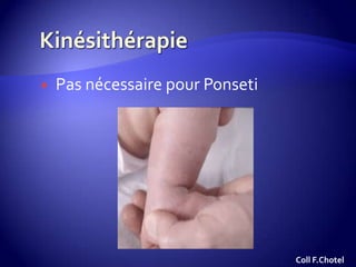  Pas nécessaire pour Ponseti
Coll F.Chotel
 