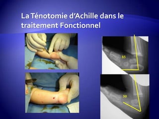 LaTénotomie d’Achille dans le
traitement Fonctionnel
85
50
 