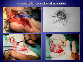 •Ouverture de laTA et libération du NFPE
 