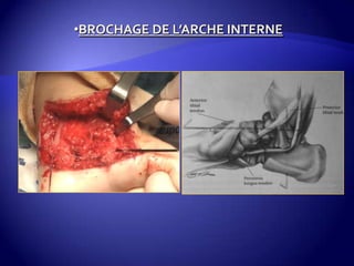 •BROCHAGE DE L’ARCHE INTERNE
 
