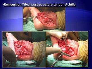 •RéinsertionTibial post et suture tendon Achille
 