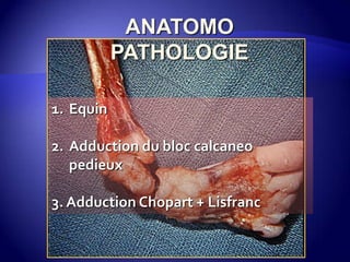ANATOMO
PATHOLOGIE
1. Equin
2. Adduction du bloc calcaneo
pedieux
3. Adduction Chopart + Lisfranc
 