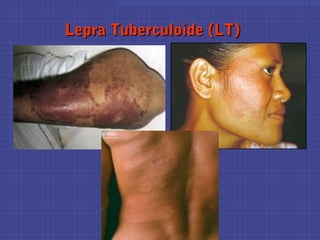Lepra Tuberculoide (LT)Lepra Tuberculoide (LT)
 