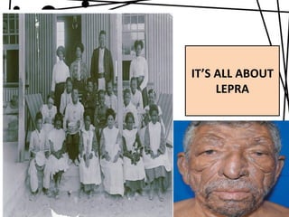 IT’S ALL ABOUT
LEPRA

 
