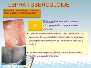 LEPRA TUBERCULOIDE
Forma frecuente benigna, estable,
toma la piel y nervios periféricos

Cutáneo: lesiones eritematosas,

Cx

micropapuloides, en placas bien
definidas

• Lesiones ovales o redondeadas, bien delimitadas, con
trastornos de la sensibilidad, disminución de pigmento
con alopecia y disminución de la secreción sebácea y
sudoral
• Localizada en regiones glúteas, cara posterior de los
muslos y región dorsolumbar

 