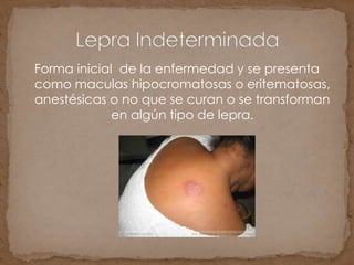 Forma inicial de la enfermedad y se presenta
como maculas hipocromatosas o eritematosas,
anestésicas o no que se curan o se transforman
en algún tipo de lepra.
 
