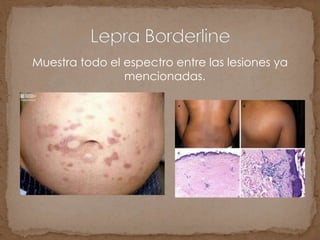 Muestra todo el espectro entre las lesiones ya
mencionadas.
 