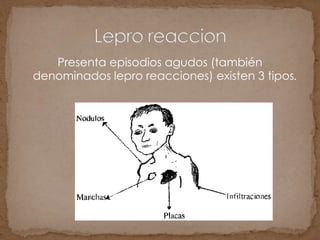 Presenta episodios agudos (también
denominados lepro reacciones) existen 3 tipos.
 