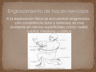 A la exploración física se encuentran engrosados
con consistencia dura y dolorosa, es mas
evidente en nervios superficiales como: radial,
cubital, mediano y ciático.
 