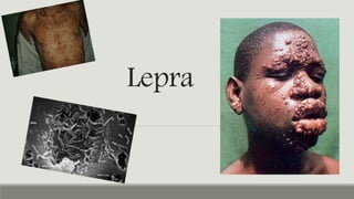 Lepra
 