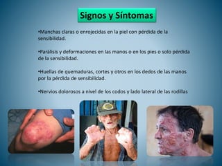 Signos y Síntomas
•Manchas claras o enrojecidas en la piel con pérdida de la
sensibilidad.
•Parálisis y deformaciones en l...