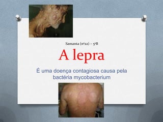 Samanta (nº22) – 5ºB



        A lepra
É uma doença contagiosa causa pela
      bactéria mycobacterium
 