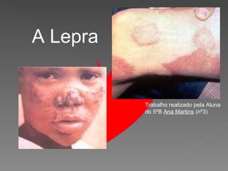 A Lepra Trabalho realizado pela Aluna do 5ºB  Ana Martins  (nº3) 