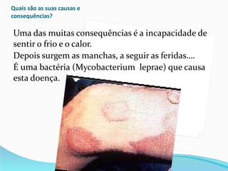 Quais são as suas causas e consequências?  Uma das muitas consequências é a incapacidade de sentir o frio e o calor. Depois surgem as manchas, a seguir as feridas…. É uma bactéria (Mycobacterium  leprae) que causa esta doença. 