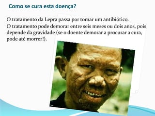 Como se cura esta doença? O tratamento da Lepra passa por tomar um antibiótico. O tratamento pode demorar entre seis meses ou dois anos, pois depende da gravidade (se o doente demorar a procurar a cura, pode até morrer!). 