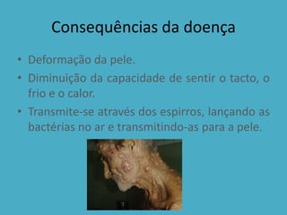 Consequências da doença
• Deformação da pele.
• Diminuição da capacidade de sentir o tacto, o
  frio e o calor.
• Transmite-se através dos espirros, lançando as
  bactérias no ar e transmitindo-as para a pele.
 