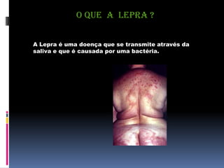 O QUE A LEPRA ?
A Lepra é uma doença que se transmite através da
saliva e que é causada por uma bactéria.
 
