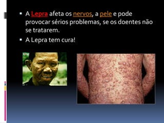 A Lepra afeta os nervos, a pele e pode
provocar sérios problemas, se os doentes não
se tratarem.
 A Lepra tem cura!
 