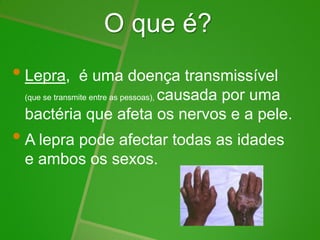 O que é?
• Lepra, é uma doença transmissível
(que se transmite entre as pessoas), causada por uma
bactéria que afeta os nervos e a pele.
• A lepra pode afectar todas as idades
e ambos os sexos.
 