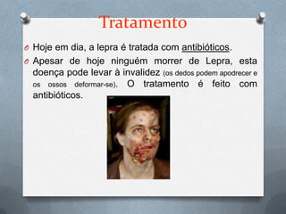 Tratamento
O Hoje em dia, a lepra é tratada com antibióticos.
O Apesar de hoje ninguém morrer de Lepra, esta
  doença pode levar à invalidez (os dedos podem apodrecer e
  os ossos deformar-se). O tratamento é feito com
  antibióticos.
 