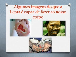 Algumas imagens do que a
Lepra é capaz de fazer ao nosso
            corpo
 