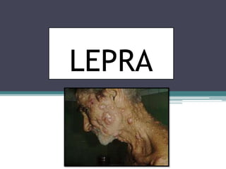 LEPRAA