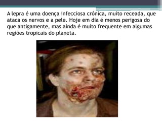 A lepra é uma doença infecciosa crónica, muito receada, que
ataca os nervos e a pele. Hoje em dia é menos perigosa do
que antigamente, mas ainda é muito frequente em algumas
regiões tropicais do planeta.