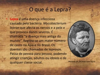 O que é a Lepra?
• Lepra é uma doença infecciosa
  causada pela bactéria Mycobacterium
  leprae que afecta os nervos e a pele e
  que provoca danos severos. É
  chamada “a doença mais antiga do
  mundo”. Regista-se um maior número
  de casos na Ásia e no Brasil. Os
  doentes são chamados de leprosos.
  Passa de pessoa para pessoa, podendo
  atingir crianças, adultos ou idosos e de
                                             Homem de 24 anos com lepra.
  qualquer classe social.
 