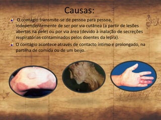 Causas:
 O contágio transmite-se de pessoa para pessoa,
independentemente de ser por via cutânea (a partir de lesões
abertas na pele) ou por via área (devido à inalação de secreções
respiratórias contaminados pelos doentes da lepra).
O contágio acontece através de contacto íntimo e prolongado, na
partilha de comida ou de um beijo.
 