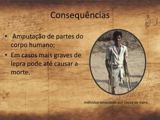 Consequências

• Amputação de partes do
  corpo humano;
• Em casos mais graves de
  lepra pode até causar a
  morte.



                            Individuo amputado por causa da lepra.
 