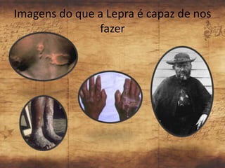 Imagens do que a Lepra é capaz de nos
               fazer
 