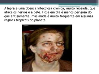 A lepra é uma doença infecciosa crónica, muito receada, que
ataca os nervos e a pele. Hoje em dia é menos perigosa do
que antigamente, mas ainda é muito frequente em algumas
regiões tropicais do planeta.
 
