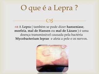O que é a Lepra ?
                    
 A Lepra ( também se pode dizer hanseníase,
morfeia, mal de Hansen ou mal de Lázaro ) é uma
   doença transmissivel causada pela bactéria
Mycobacterium leprae e afeta a pele e os nervos.
 