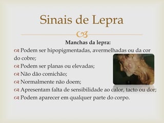 Sinais de Lepra
                 
                   Manchas da lepra:
 Podem ser hipopigmentadas, avermelhadas ou da cor
do cobre;
 Podem ser planas ou elevadas;
 Não dão comichão;
 Normalmente não doem;
 Apresentam falta de sensibilidade ao calor, tacto ou dor;
 Podem aparecer em qualquer parte do corpo.
 