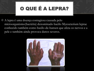 O QUE É A LEPRA?

 A lepra é uma doença contagiosa causada pelo
  microorganismo(bactéria) denominado bacilo Mycocterium leprae
  conhecido também como basilo-de-hansen que afeta os nervos e a
  pele e também ainda provoca danos severos.
 