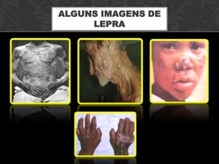 ALGUNS IMAGENS DE
     LEPRA
 