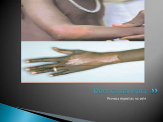Doença da lepra
   Provoca manchas na pele
 