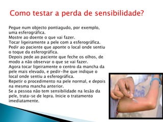 Como testar a perda de sensibilidade?
Pegue num objecto pontiagudo, por exemplo,
uma esferográfica.
Mostre ao doente o que vai fazer.
Tocar ligeiramente a pele com a esferográfica.
Pedir ao paciente que aponte o local onde sentiu
o toque da esferográfica.
Depois pede ao paciente que feche os olhos, de
modo a não observar o que se vai fazer.
Agora tocar ligeiramente o centro da mancha da
pele mais elevado, e pedir-lhe que indique o
local onde sentiu a esferográfica.
Repetir o procedimento na pele normal, e depois
na mesma mancha anterior.
Se a pessoa não tem sensibilidade na lesão da
pele, trata-se de lepra. Inicie o tratamento
imediatamente.
 
