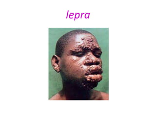 lepra
 