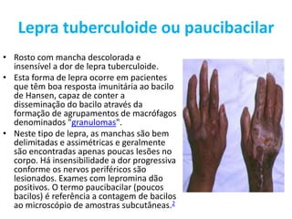 Lepra tuberculoide ou paucibacilar
• Rosto com mancha descolorada e
insensível a dor de lepra tuberculoide.
• Esta forma de lepra ocorre em pacientes
que têm boa resposta imunitária ao bacilo
de Hansen, capaz de conter a
disseminação do bacilo através da
formação de agrupamentos de macrófagos
denominados "granulomas".
• Neste tipo de lepra, as manchas são bem
delimitadas e assimétricas e geralmente
são encontradas apenas poucas lesões no
corpo. Há insensibilidade a dor progressiva
conforme os nervos periféricos são
lesionados. Exames com lepromina dão
positivos. O termo paucibacilar (poucos
bacilos) é referência a contagem de bacilos
ao microscópio de amostras subcutâneas.2
 