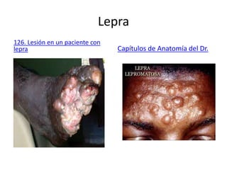 Lepra
126. Lesión en un paciente con
lepra Capítulos de Anatomía del Dr.
 
