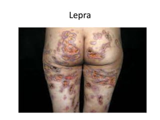 Lepra
 