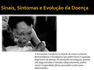 A hanseníase manifesta-se através de sinais e sintomas
dermatológicos e neurológicos que podem levar à suspeição
diagnóstica da doença. As alterações neurológicas, quando
não diagnosticadas e tratadas adequadamente, podem
causar incapacidades físicas que podem evoluir para
deformidades...
Sinais, Sintomas e Evolução da Doença
 